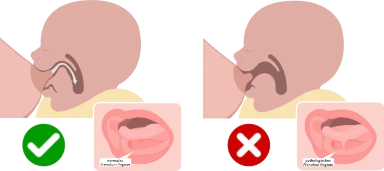 Zungenband normales und pathologisches Zungenbändchen